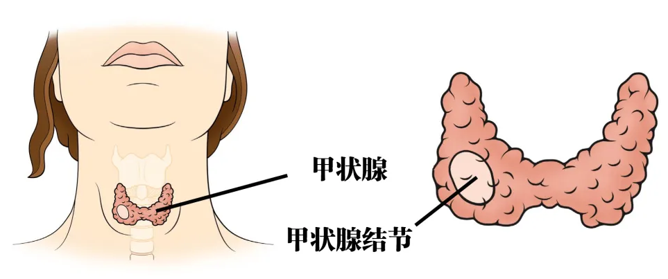 9 个瑜伽体式刺激甲状腺，调节内分泌，清除身体垃圾！  甲状腺疾病 甲状腺 瑜伽疗愈甲状腺 第 1 张