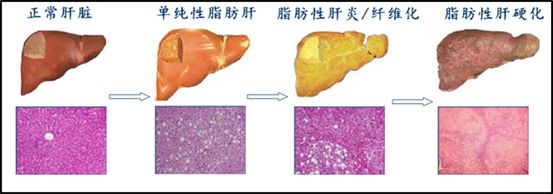 年轻人“发病率最高”的肝病是「脂肪肝」！ 9 个体式助你养好肝！