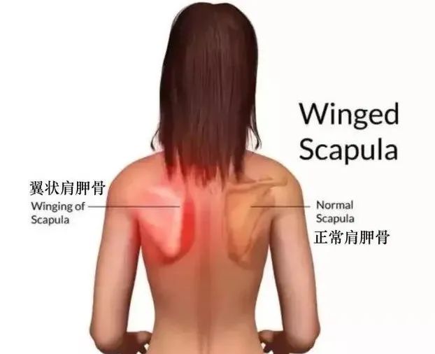 你眼中的性感美背，可能是“病”！  第 3 张