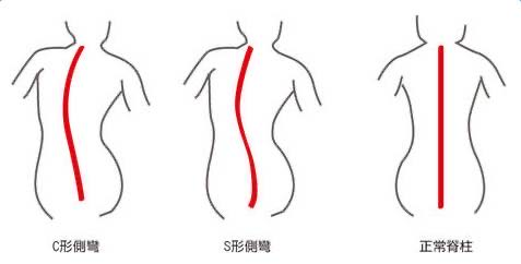 脊柱侧弯，长短腿？原来都是“跷二郎腿”惹得祸！（附瑜伽理疗）  第 2 张