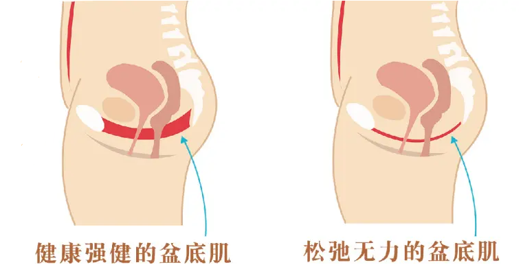 9 个瑜伽变体“ 靠墙 ”练，加强「盆底肌」超级有效！  盆底肌 夫妻性生活 阴道松弛 阴吹 大小便失禁 漏尿 第 1 张