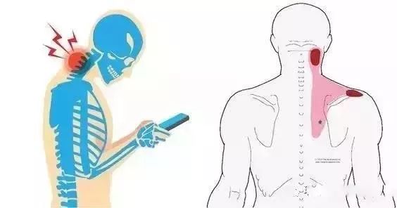 脖子还在前伸？当心颈椎病、富贵包！  颈椎病 富贵包 第 1 张