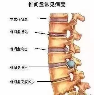 医生推荐的这组瑜伽体式，练完腰椎好了，腰也细了，太厉害了！  腰椎间盘突出 腰椎间盘膨出 腰椎间盘脱出 腰痛 第 3 张