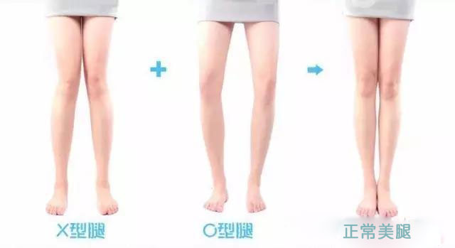 什么是超伸? 你的关节是在超伸吗? 第 4 张 什么是超伸? 你的关节是在超伸吗? 第 4 张
