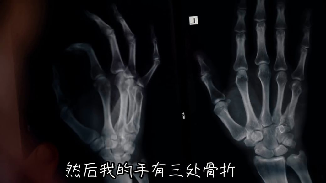 他练阿斯汤加 10 多年,经历车祸差点瘫痪,1 年后重新开始,让无数人感动! 第 3 张 他练阿斯汤加 10 多年,经历车祸差点瘫痪,1 年后重新开始,让无数人感动! 第 3 张