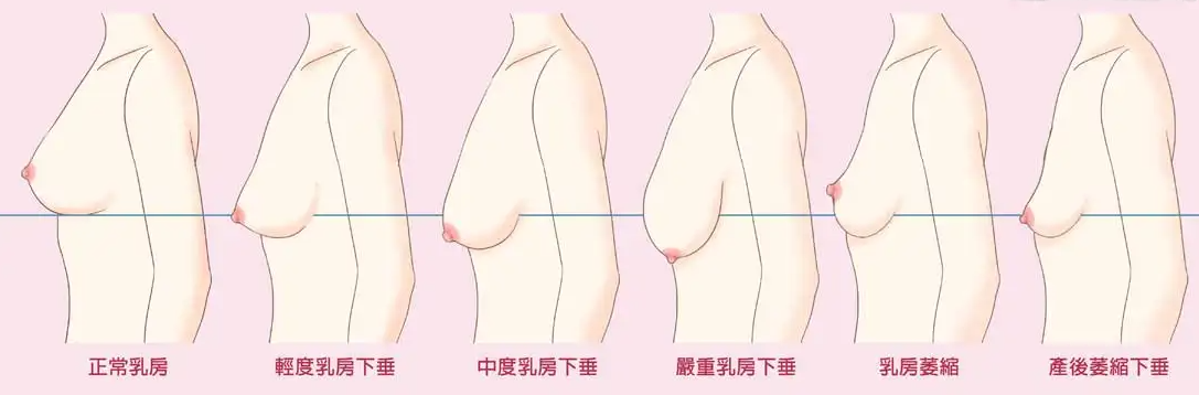 产后瑜伽理疗乳房的修复过程中的时间及注意点, 关键点  产后瑜伽 产后乳房 产后修复 第 2 张