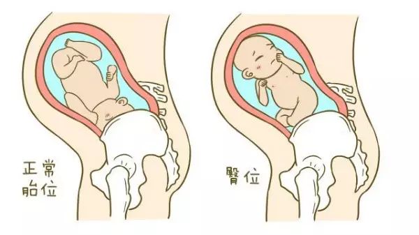 「孕妈收藏」成功调整了 2000 个胎位不正的宝妈后,我把方法汇总在了这篇文章内 第 5 张 「孕妈收藏」成功调整了 2000 个胎位不正的宝妈后,我把方法汇总在了这篇文章内 第 5 张