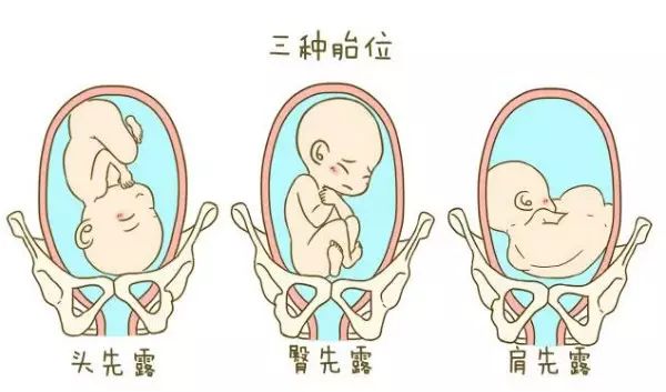 「孕妈收藏」成功调整了2000个胎位不正的宝妈后，我把方法汇总在了这篇文章内