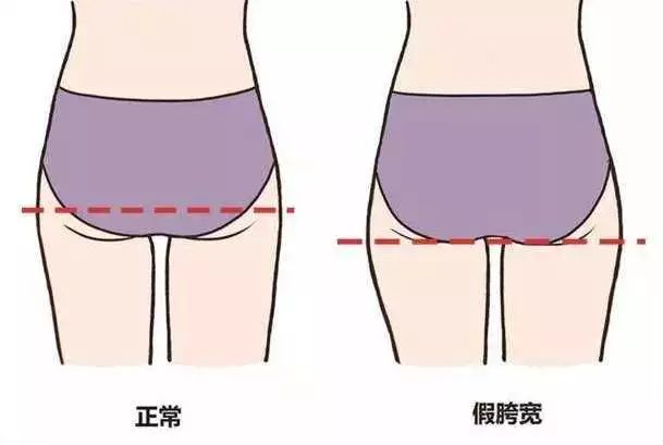 大腿粗怎么瘦?你可能中招了这 6 点!附大腿内、外、前、后赘肉练习 第 2 张 大腿粗怎么瘦?你可能中招了这 6 点!附大腿内、外、前、后赘肉练习 第 2 张