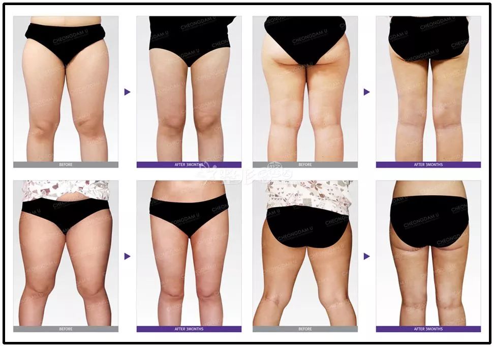 大腿粗怎么瘦?你可能中招了这 6 点!附大腿内、外、前、后赘肉练习 第 3 张 大腿粗怎么瘦?你可能中招了这 6 点!附大腿内、外、前、后赘肉练习 第 3 张