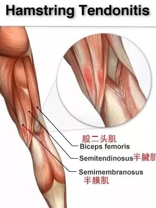 有一种痛,叫瑜伽痛!如何向大腿内侧受伤 Say No? 第 3 张 有一种痛,叫瑜伽痛!如何向大腿内侧受伤 Say No? 第 3 张