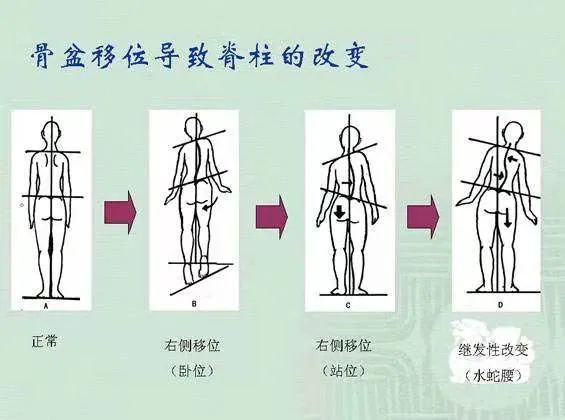 90% 的人骨盆移位 , 需要瑜伽来矫正! 骨盆 肌肉 骨盆移位 跷二郎腿 办公臀 移位 第 5 张 90% 的人骨盆移位 , 需要瑜伽来矫正! 骨盆 肌肉 骨盆移位 跷二郎腿 办公臀 移位 第 5 张