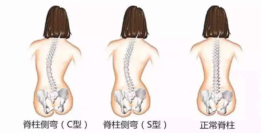 它很重要!却最少被拉伸,容易造成腰疼、脊柱侧弯! 呼吸 腰椎 腰方肌 身体 脊柱侧弯 脊柱 右脚 第 1 张 它很重要!却最少被拉伸,容易造成腰疼、脊柱侧弯! 呼吸 腰椎 腰方肌 身体 脊柱侧弯 脊柱 右脚 第 1 张
