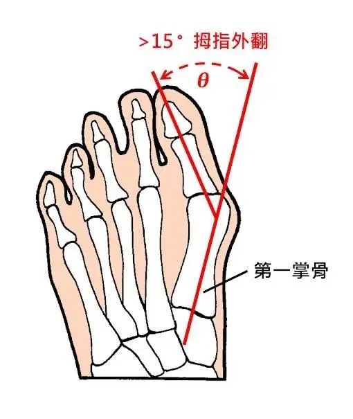 拇趾/拇指外翻是什么？如何运用瑜伽缓解拇趾外翻？（瑜伽治疗拇指外翻）