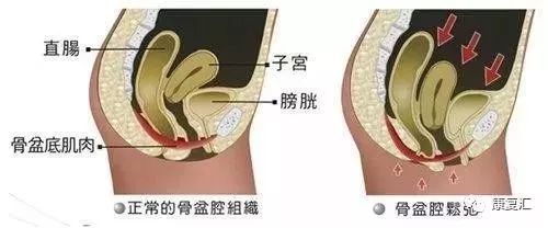 产后骨盆修复、盆底肌康复、腹直肌分离康复——图解 + 详解都在这里 瑜伽 盆底肌 产后修复 盆底肌康复 产后骨盆修复 腹直肌分离康复 第 21 张 产后骨盆修复、盆底肌康复、腹直肌分离康复——图解 + 详解都在这里 瑜伽 盆底肌 产后修复 盆底肌康复 产后骨盆修复 腹直肌分离康复 第 21 张