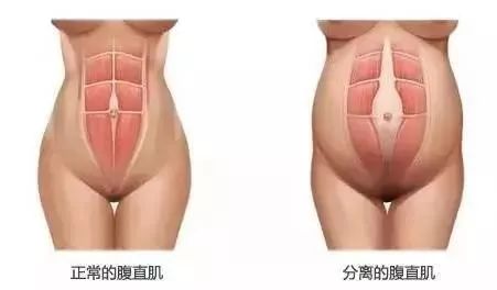产后骨盆修复、盆底肌康复、腹直肌分离康复——图解 + 详解都在这里 瑜伽 盆底肌 产后修复 盆底肌康复 产后骨盆修复 腹直肌分离康复 第 36 张 产后骨盆修复、盆底肌康复、腹直肌分离康复——图解 + 详解都在这里 瑜伽 盆底肌 产后修复 盆底肌康复 产后骨盆修复 腹直肌分离康复 第 36 张