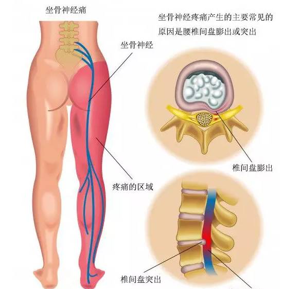 孕期坐骨神经痛?瑜伽理疗得用上！（孕期缓解坐骨神经痛的瑜伽）