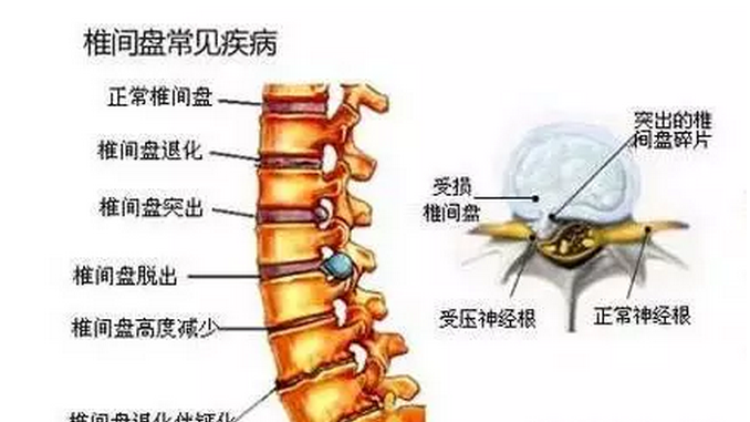 腰椎间盘突出可以报理疗瑜伽培训班么? 腰椎间盘 腰部 症状 瑜伽 肌肉 椎间盘 腰椎 第 2 张 腰椎间盘突出可以报理疗瑜伽培训班么? 腰椎间盘 腰部 症状 瑜伽 肌肉 椎间盘 腰椎 第 2 张