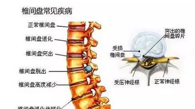 腰椎间盘突出可以报理疗瑜伽培训班么？（腰椎间盘突出可以报理疗瑜伽培训班么）