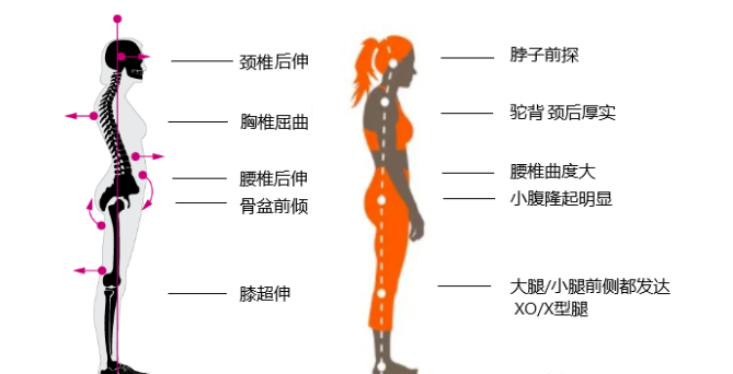 瑜伽培训. 瑜伽私教课的体态和体态自我评估, 健康美丽的头等大事 | 干货 体态 膝盖 问题 姿势 脊柱 身体 曲度 第 8 张 瑜伽培训. 瑜伽私教课的体态和体态自我评估, 健康美丽的头等大事 | 干货 体态 膝盖 问题 姿势 脊柱 身体 曲度 第 8 张