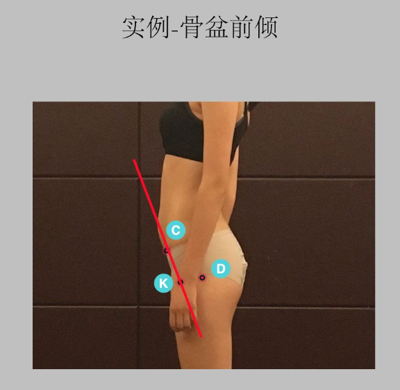 瑜伽培训. 瑜伽私教课的体态和体态自我评估, 健康美丽的头等大事 | 干货 体态 膝盖 问题 姿势 脊柱 身体 曲度 第 30 张 瑜伽培训. 瑜伽私教课的体态和体态自我评估, 健康美丽的头等大事 | 干货 体态 膝盖 问题 姿势 脊柱 身体 曲度 第 30 张