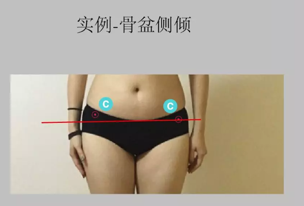 瑜伽培训. 瑜伽私教课的体态和体态自我评估, 健康美丽的头等大事 | 干货 体态 膝盖 问题 姿势 脊柱 身体 曲度 第 43 张 瑜伽培训. 瑜伽私教课的体态和体态自我评估, 健康美丽的头等大事 | 干货 体态 膝盖 问题 姿势 脊柱 身体 曲度 第 43 张