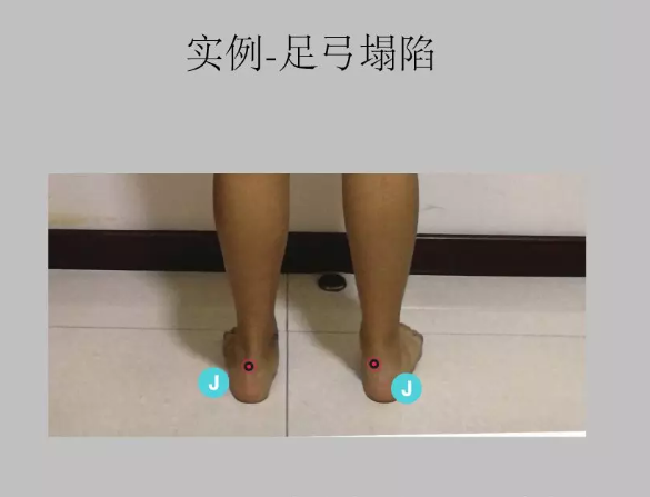 瑜伽培训. 瑜伽私教课的体态和体态自我评估, 健康美丽的头等大事 | 干货 体态 膝盖 问题 姿势 脊柱 身体 曲度 第 56 张 瑜伽培训. 瑜伽私教课的体态和体态自我评估, 健康美丽的头等大事 | 干货 体态 膝盖 问题 姿势 脊柱 身体 曲度 第 56 张